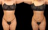 Patient was nearly at her ideal body appearance, but struggled with a few remaining pockets of fat. She underwent liposuction to remove the fat and saw impressive results that bring out her natural body features with a smoother torso in front and back.