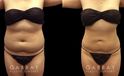Patient’s surgical belly fat removal results reveal significant slimming after her procedure, with virtually no belly overhang for a flat profile contour.