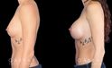Breast augmentation patient with final results Note the significant increase in breast volume while keeping the shape within natural bounds. Note the absence of visible scarring which is rare with such increases in breast volume.