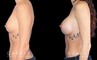 Breast augmentation patient with final results Note the significant increase in breast volume while keeping the shape within natural bounds. Note the absence of visible scarring which is rare with such increases in breast volume.