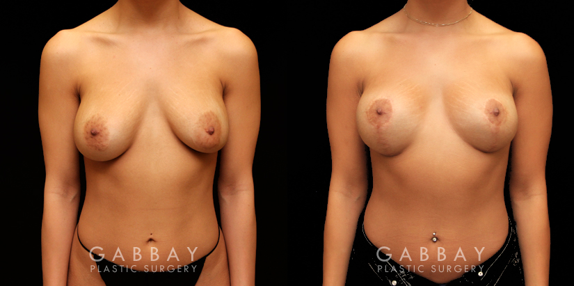 Procedures Depicted:  Removal and Replacement of SIL Implants; capsulorrhaphy