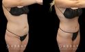 Mild tummy tuck results photos showing the patient’s smoother abdomen, absence of visible scarring, and natural appearance to results. Rather than look like a surgery, the slimming effect blends with her natural features.