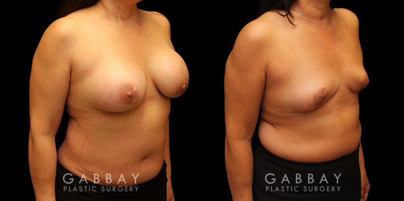 Procedures Depicted:  Auto Augmentation with lift