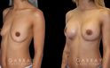 Silicone implant breast augmentation with correction of unilateral breast drooping. Results allowed for improved breast position without need for additional mastopexy procedure.