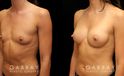 This is an extremely athletic woman who wanted a softer look for her torso. She had silicone breast augmentation using Allergan Natrelle soft touch moderate profile implants placed through a lower breast/inframammary incision and under her muscle in a dual plane position.. Her implants were 255 cc.