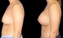 Silicone breast augmentation results, with patient having notable increase in breast volume and protrusion. But the breasts still maintain a balance between them.