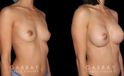 Patient result photos following silicone implant breast augmentation. Patient elected for a rounder shape with mild breast protrusion for subtle yet alluring results.