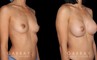 Patient result photos following silicone implant breast augmentation. Patient elected for a rounder shape with mild breast protrusion for subtle yet alluring results.