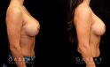 Patient 02 Right Side View Breast Revision Gabbay Plastic Surgery