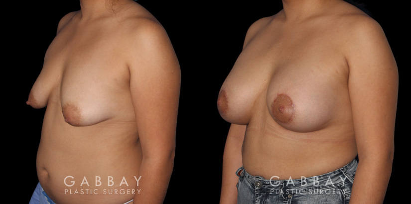 Procedures Depicted:  Breast Augmentation – Silicone & Lift