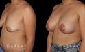 Procedures Depicted:  Breast Augmentation – Silicone & Lift