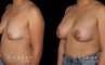 Procedures Depicted:  Breast Augmentation – Silicone & Lift
