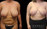Patient 07 Front View Breast Reduction with Lift Gabbay Plastic Surgery