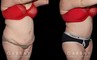 Patient before and after her tummy tuck procedure combined with liposuction around the waist. The final effect is slimming from multiple angles with no visible scarring. Note the smoother texture of skin and lending to a more youthful visual.