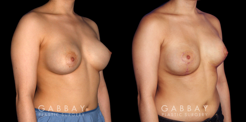 Procedures Depicted:  Breast Augmentation-Remove and Replace Saline & Full Lift