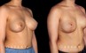 Procedures Depicted:  Breast Augmentation-Remove and Replace Saline & Full Lift
