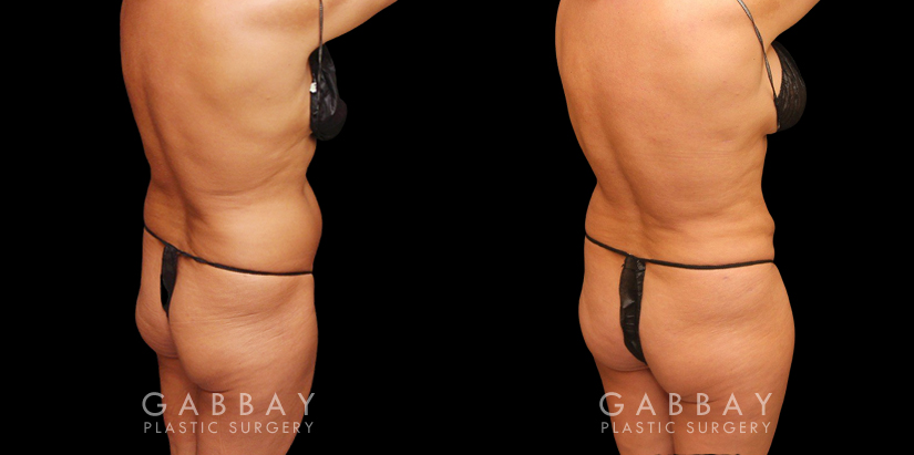 Procedures Depicted:  liposuction and j plasma to full abdomen Female African-American patient after liposuction and J plasma treatment to her full abdomen, reducing her bulging belly and to tighten and restore loose skin.