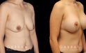 Scar revision to breasts results with additional breast augmentation and lift combination. Patient improved breast size and position with mild scarring only.