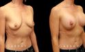 Procedures Depicted:  Breast augmentation with areola lift
