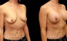 Procedures Depicted:  Breast augmentation with areola lift