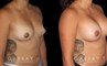 Breast Augmentation before-and-after photos demonstrating increased breast volume using silicone implants. Patient sought a milder increase to bust while keeping the volume within a natural range.