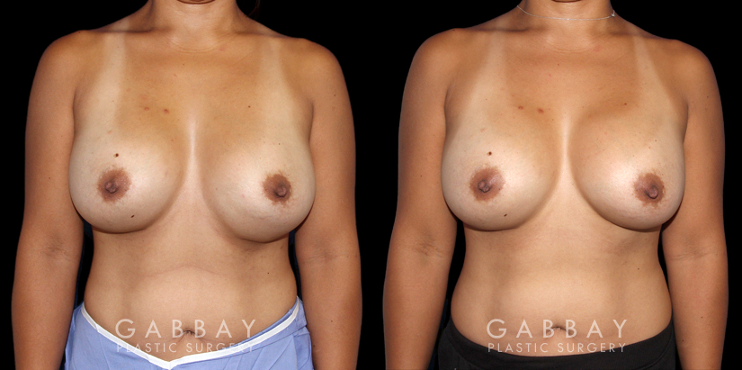 Procedures Depicted:  Breast Revision