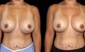 Procedures Depicted:  Breast Revision