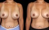 Procedures Depicted:  Breast Revision