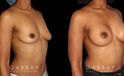Before-and-after photos for saline implant breast augmentation patient. Her implant choice allowed for more natural shape and slope to the breasts, most notable in the profile view.