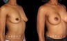 Before-and-after photos for saline implant breast augmentation patient. Her implant choice allowed for more natural shape and slope to the breasts, most notable in the profile view.