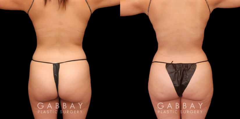 Procedures Depicted:  Lipo to abdomen and waist and fat transfer to buttock