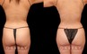 Procedures Depicted:  Lipo to abdomen and waist and fat transfer to buttock
