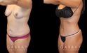 Mommy makeover patient results before and after the procedure. Before the mommy makeover, the patient had loose, excess skin and stubborn pockets of fat. After the 360 liposuction and tummy tuck, the patient’s flanks and abdomen show a flatter, smoother contour.