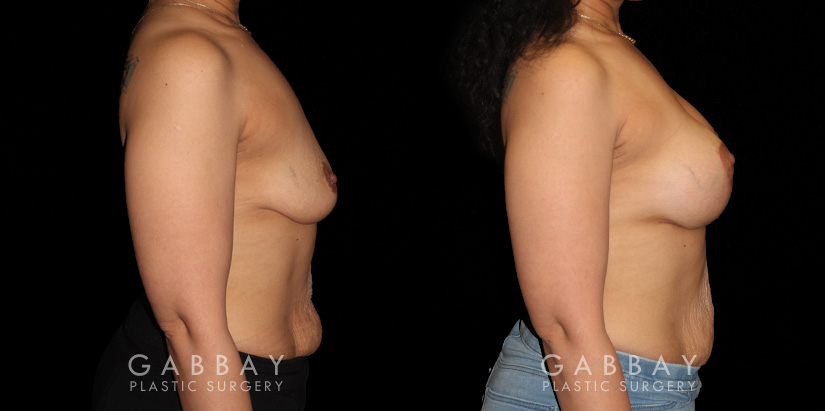 Procedures Depicted:  Breast Augmentation – Silicone & Lift