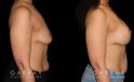 Procedures Depicted:  Breast Augmentation – Silicone & Lift