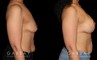 Procedures Depicted:  Breast Augmentation – Silicone & Lift