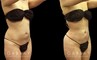 Before-and-after photo for 360 and abdominal liposuction combination. Note the emphasized contour of the waist, which in turn emphasizes the roundness of the buttocks.