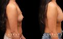 Photos of breast augmentation patient results, including before procedure and after once the patient fully recovered. Increased breast roundness allowed for the patient to see an unique aesthetic.