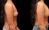 Photos of breast augmentation patient results, including before procedure and after once the patient fully recovered. Increased breast roundness allowed for the patient to see an unique aesthetic.