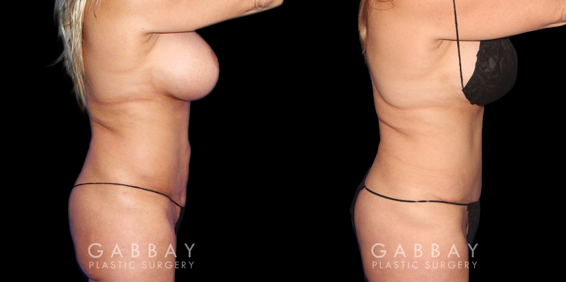 Procedures Depicted:  Abdominoplasty Abdominal tightening (tummy tuck) with liposuction shows a restored youthful figure, smoothing stomach area wrinkles for a more compact and rejuvenated appearance.