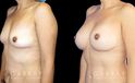 Breast augmentation results including silicone implant augmentation combined with tummy tuck and flank liposuction. The final result is a tightened body contour with enhanced breast size.