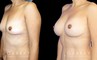 Breast augmentation results including silicone implant augmentation combined with tummy tuck and flank liposuction. The final result is a tightened body contour with enhanced breast size.