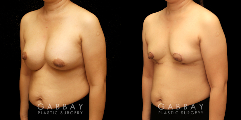 Procedures Depicted:  Breast implant removal and lift