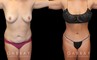 Mommy makeover patient results before and after the procedure. Before the mommy makeover, the patient had loose, excess skin and stubborn pockets of fat. After the 360 liposuction and tummy tuck, the patient’s flanks and abdomen show a flatter, smoother contour.