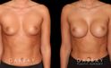 Patient results for breast augmentation. Note the rounded shape and lack of visible scarring. Patient’s recovery was smooth, absent of complications.