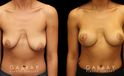 Breast lift combined with breast augmentation using silicone implants. Before-and-after photos demonstrate dramatic aesthetic enhancement of the breasts regarding shape, size, and position. Breast drooping was completely addressed and symmetry was enhanced.