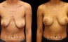 Breast lift combined with breast augmentation using silicone implants. Before-and-after photos demonstrate dramatic aesthetic enhancement of the breasts regarding shape, size, and position. Breast drooping was completely addressed and symmetry was enhanced.
