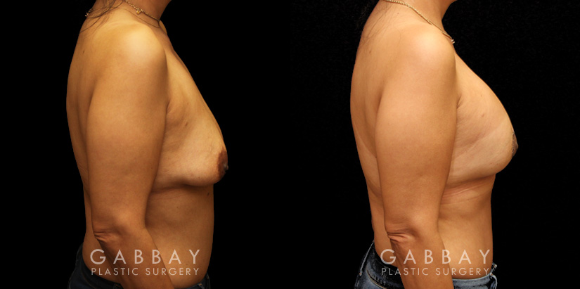 Procedures Depicted:  Breast Aug/Pexy