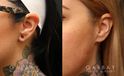 Patient 02 3/4th Left Side View Earlobe Repair Gabbay Plastic Surgery