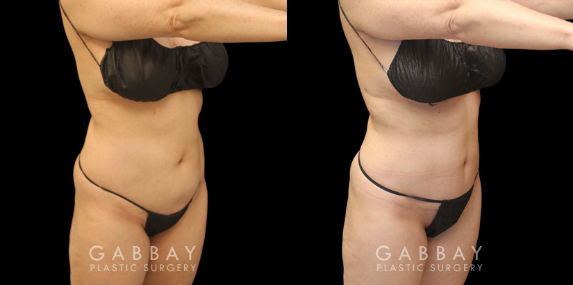 Patient 01 Front View Mini Tummy Tuck Gabbay Plastic Surgery